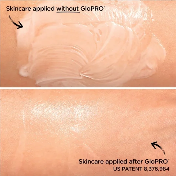 GloPRO Facial Microneedling Tool in LIMITED EDITION PINK STRIPE, New In Case - Picture 5 of 7